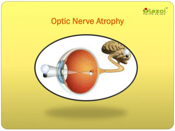 Optic Nerve Atrophy: A guide to symptoms, causes and treatment