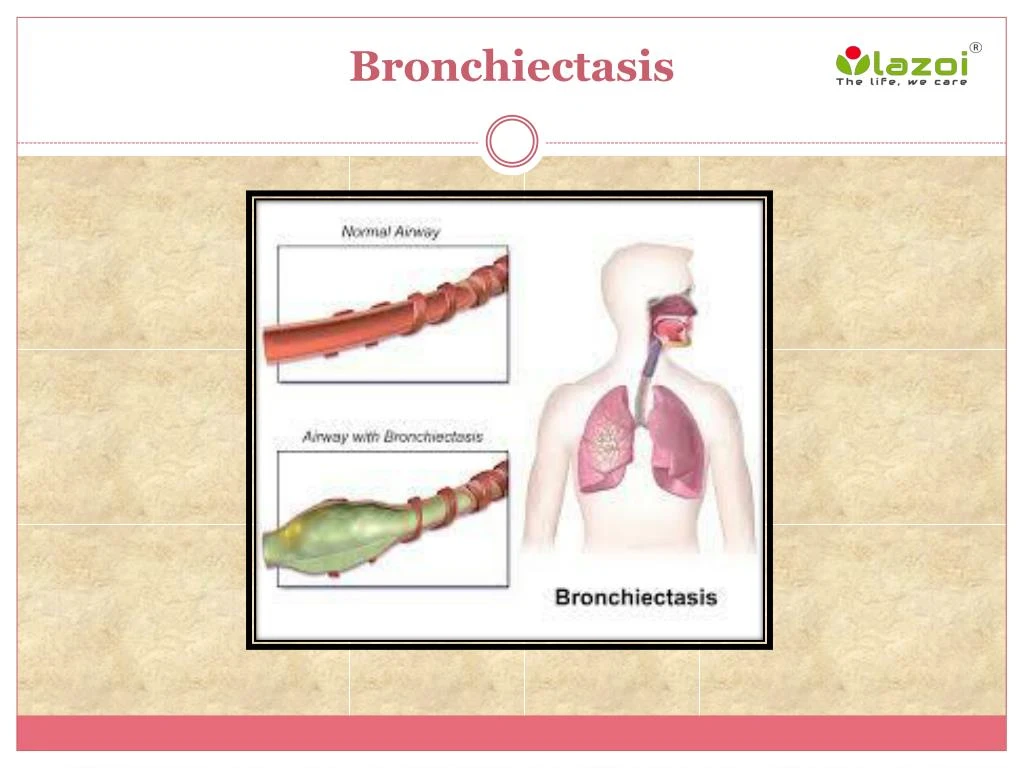 bronchiectasis