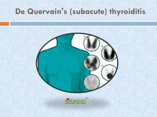 De Quervain's (subacute) thyroiditis: Symptoms, causes and more