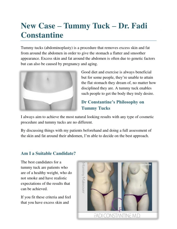 New Case – Tummy Tuck – Dr. Fadi Constantine