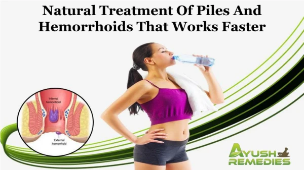 Natural Treatment of Piles and Hemorrhoids that Works Faster