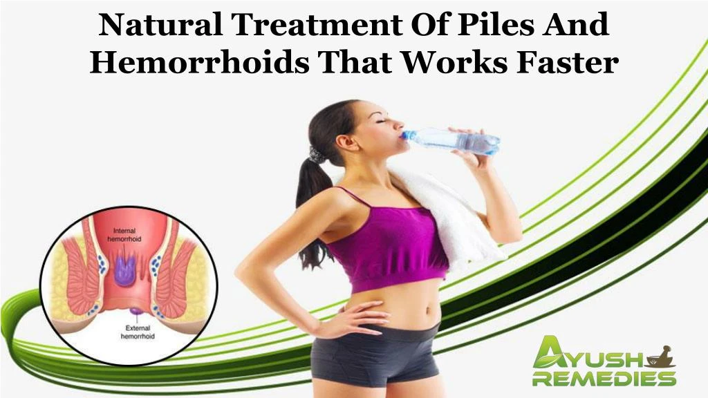 natural treatment of piles and hemorrhoids that