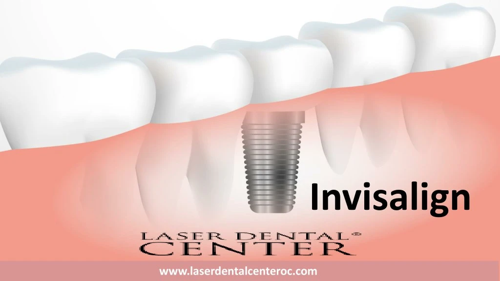 invisalign