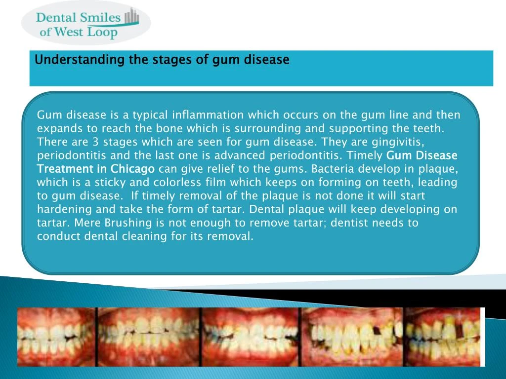 understanding the stages of gum disease