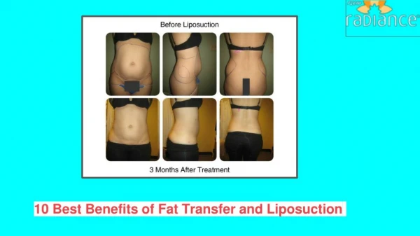 10 Best Benefits of Fat Transfer and Liposuction