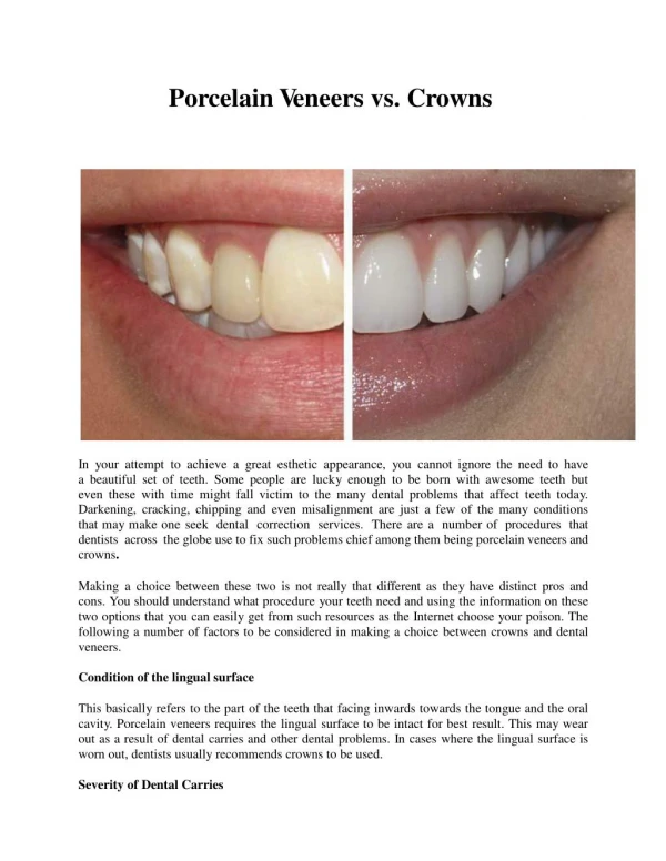 Porcelain Veneers vs. Crowns