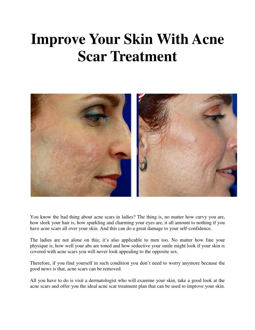 improve your skin with acne scar treatment