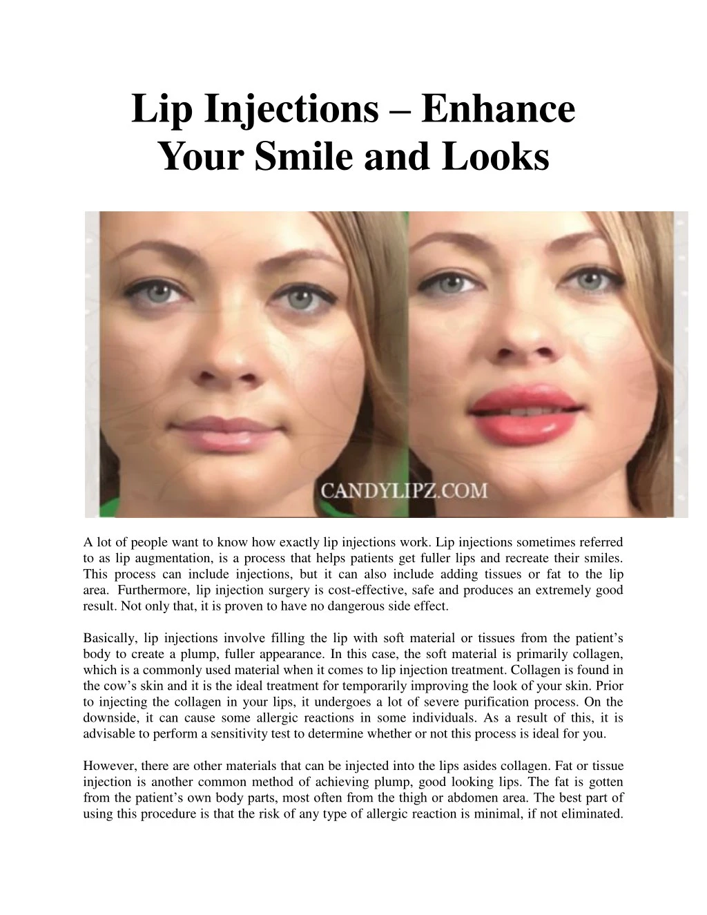 lip injections enhance your smile and looks