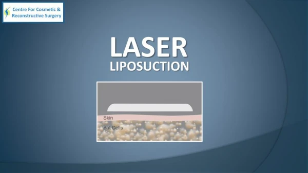 All About Laser Liposuction