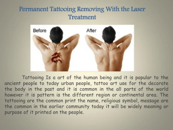Permanent Tattooing Removing With the Laser Treatment
