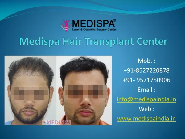 Best Hair Transplant Clinic In Dubai.