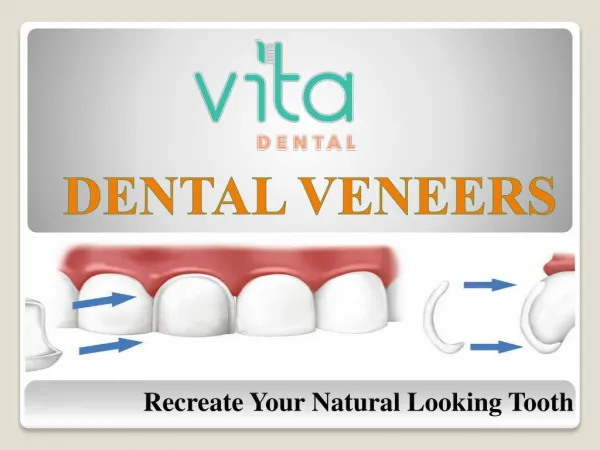 Dental Veneers Treatment- Complete Guide