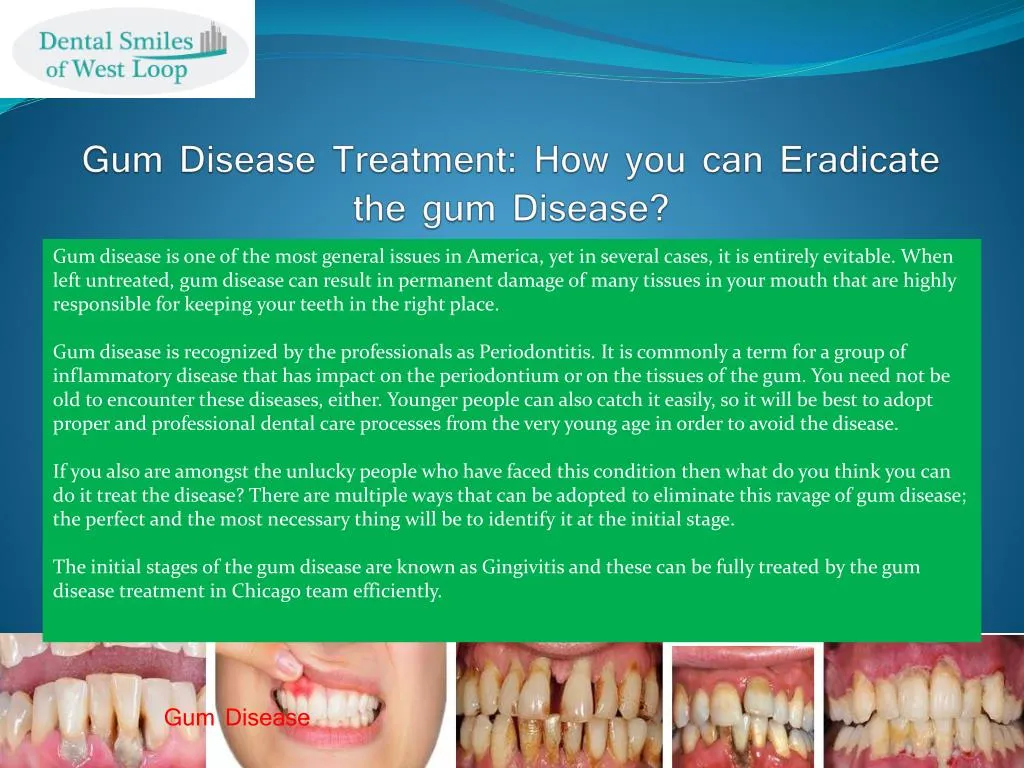 gum disease treatment how you can eradicate the gum disease