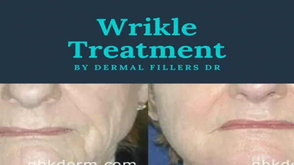 Wrinkle Treatment