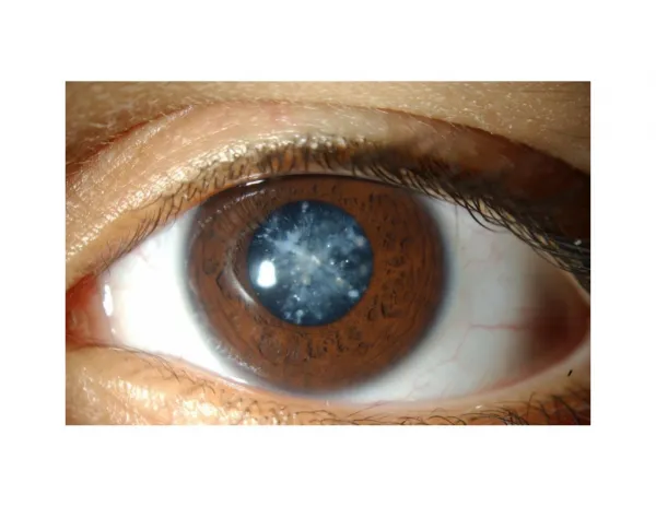 What Is A Cataract, Blind Spots In Vision, Open Angle Glaucoma Treatment, Get Rid Of Eye Floaters