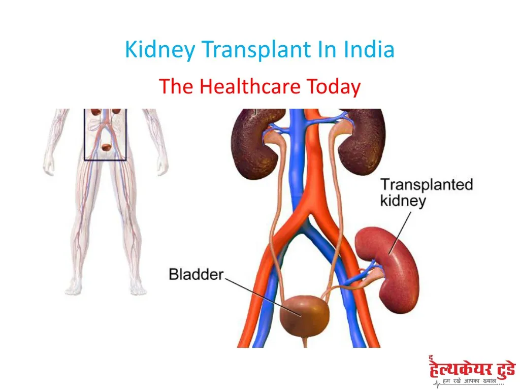 kidney transplant in india