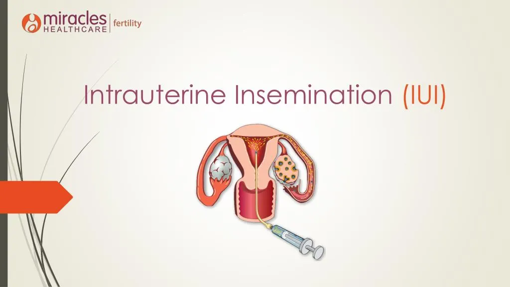 intrauterine insemination iui