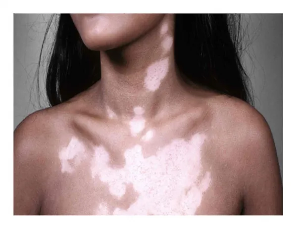 white patches on skin, white spots on skin fungus, vitiligo skin disease, vitiligo patches