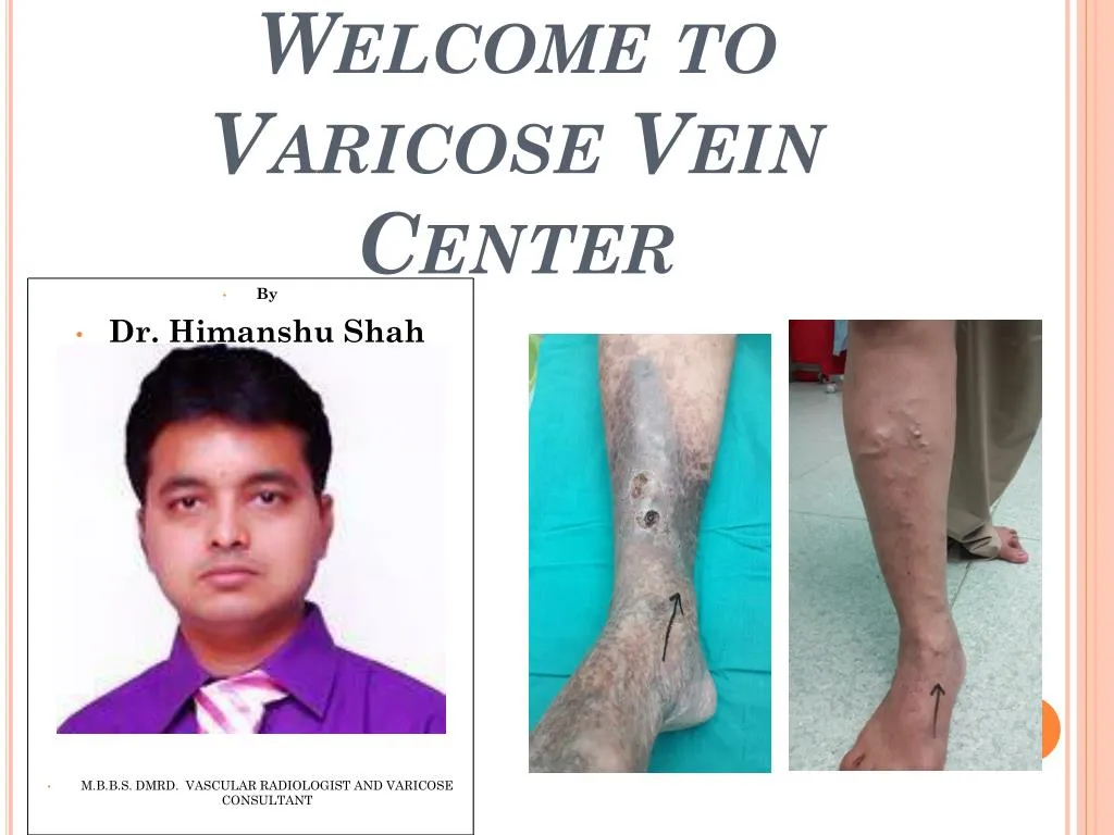 welcome to varicose vein center