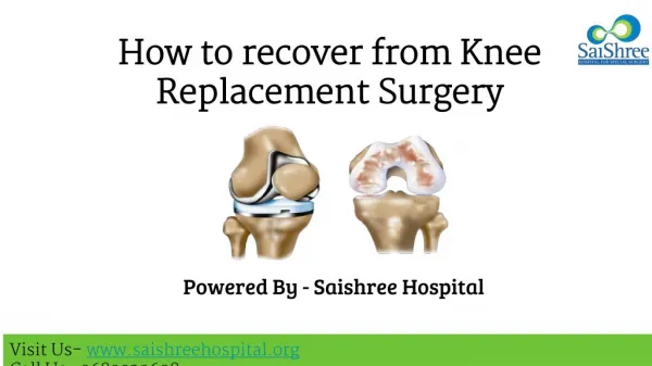 How to recover from Knee Replacement Surgery