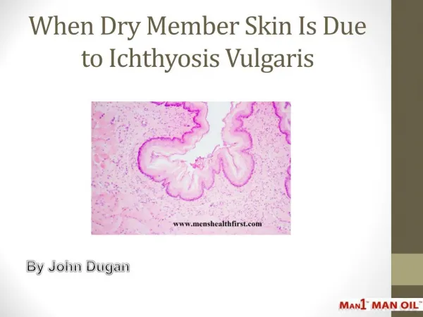 When Dry Member Skin Is Due to Ichthyosis Vulgaris