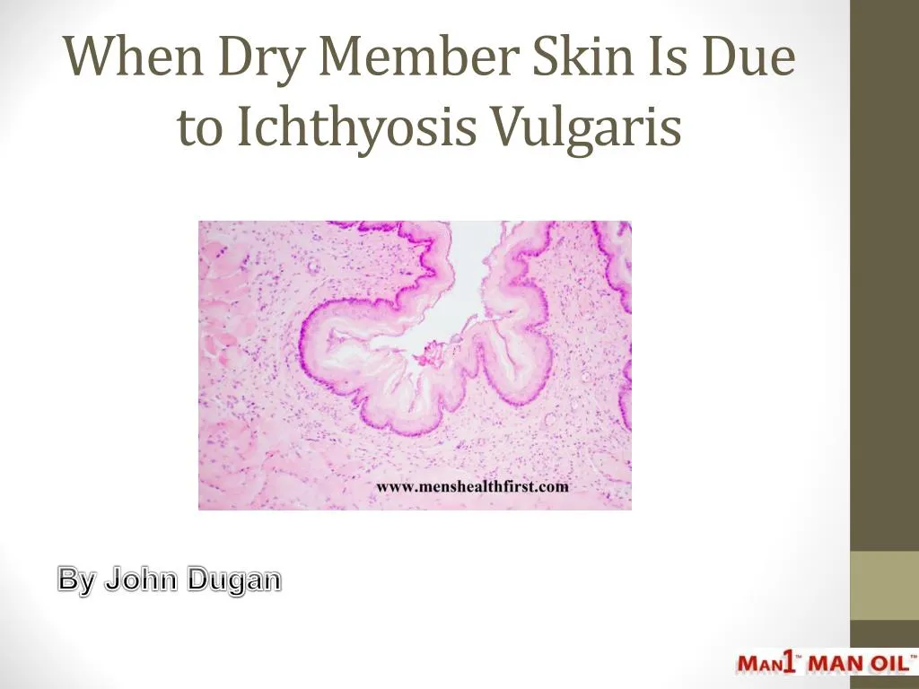 when dry member skin is due to ichthyosis vulgaris