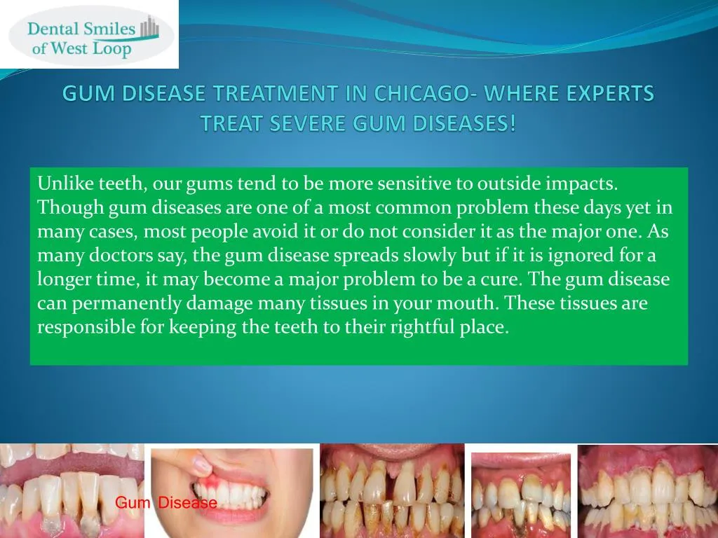 gum disease treatment in chicago where experts treat severe gum diseases