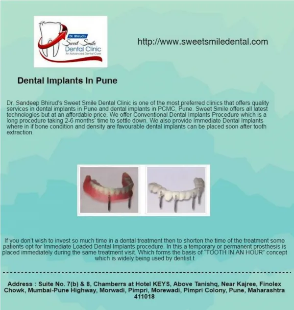 Find best dentist for dental Implants in Pune - Sweet Smile Dental Clinic