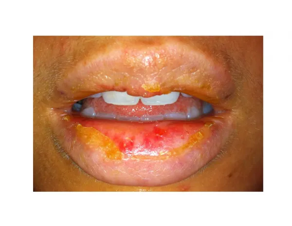 Cut In Corner Of Mouth, Angular Chelitis, Angular Cheilitis Pictures, Angular Cheilitis Vitamin