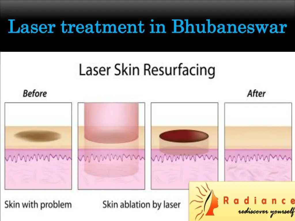 laser treatment in bhubaneswar