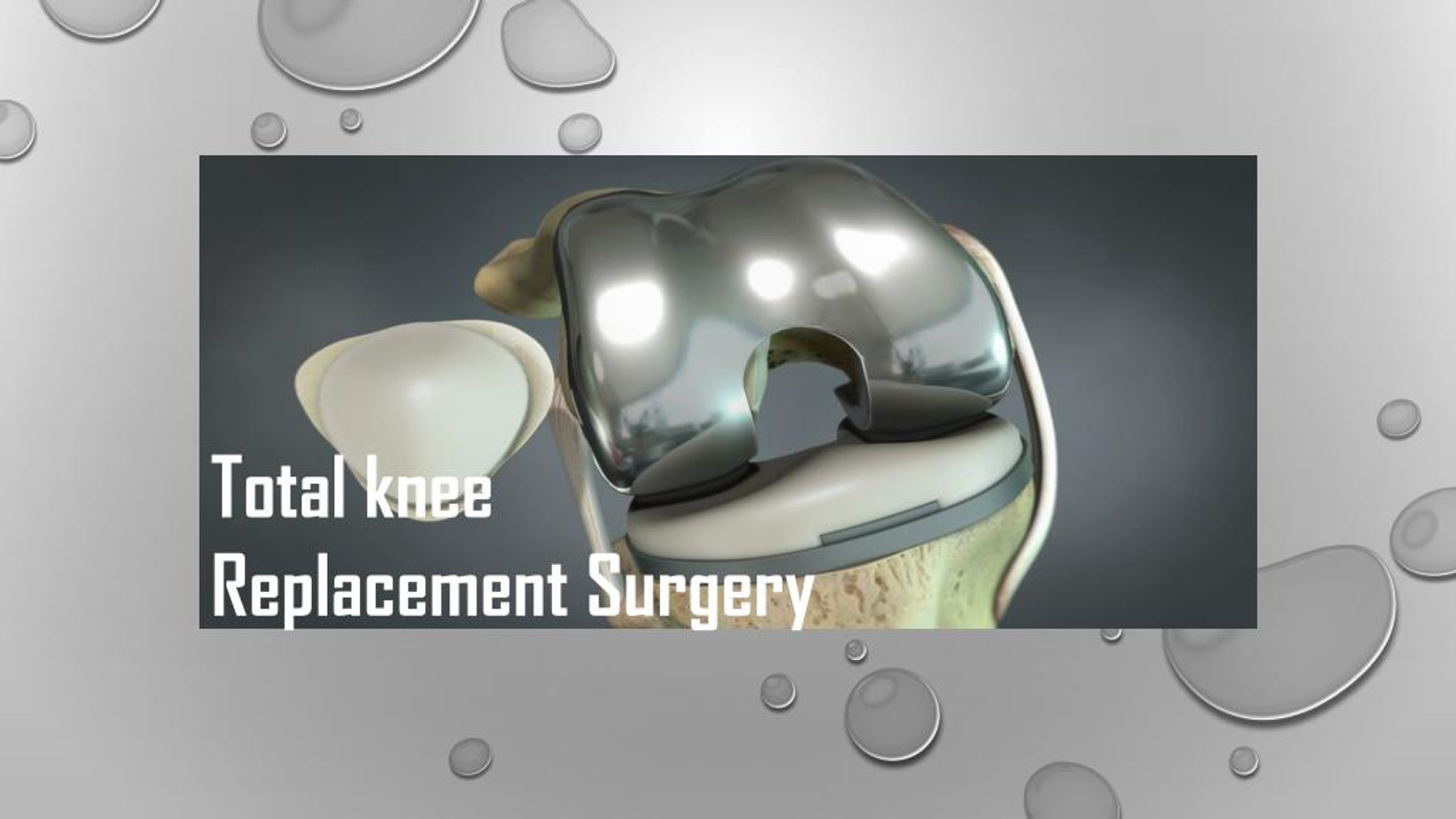 PPT - All Total Knee Replacement Surgery PowerPoint Presentation, free ...