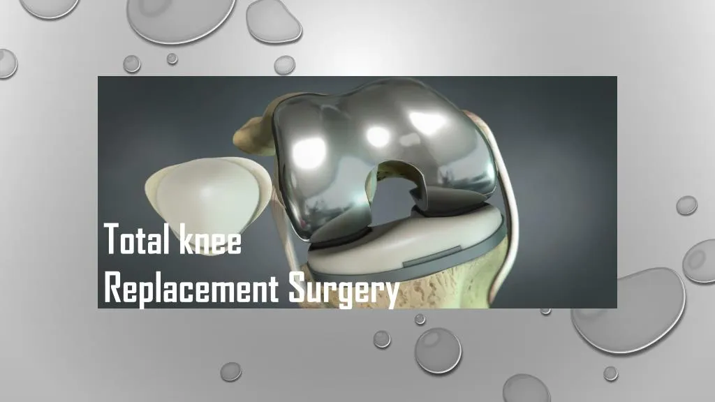 total knee replacement surgery