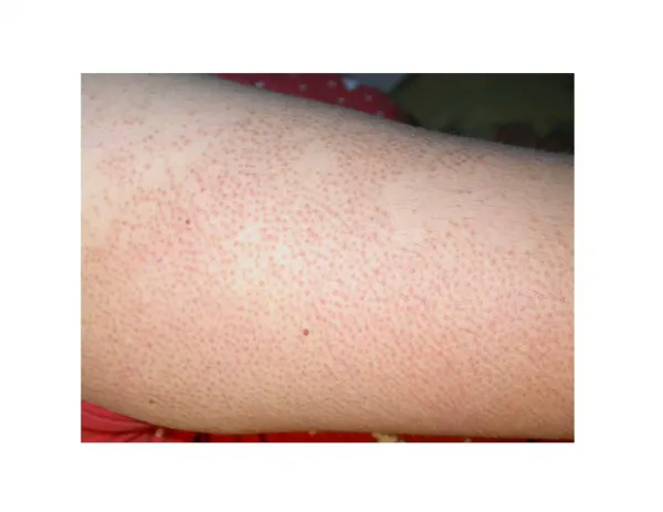 Keratosis Pilaris, Coconut Oil Keratosis Pilaris, Get Rid Of Chicken Skin, Treat Keratosis Pilaris