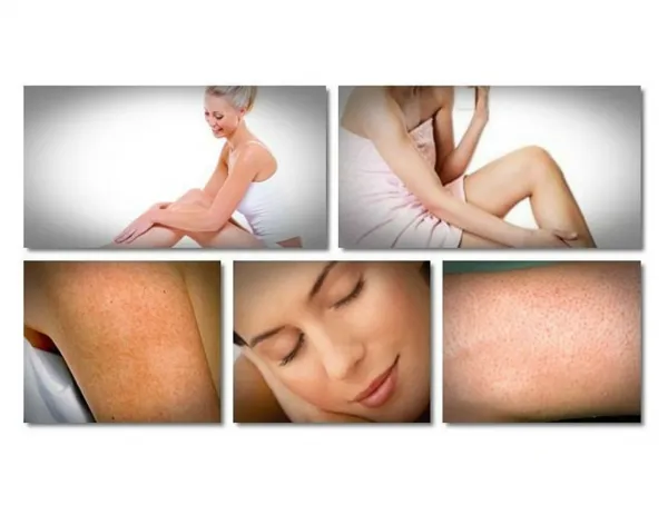 How To Get Rid Of Chicken Skin, Keratosis Pilaris Images, Cure For Keratosis Pilaris, Kp Scars