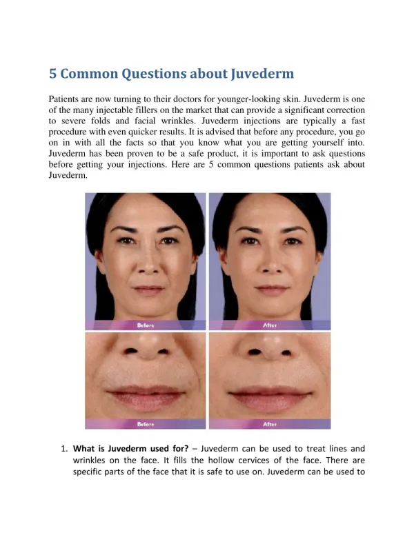 5 Common Questions about Juvederm
