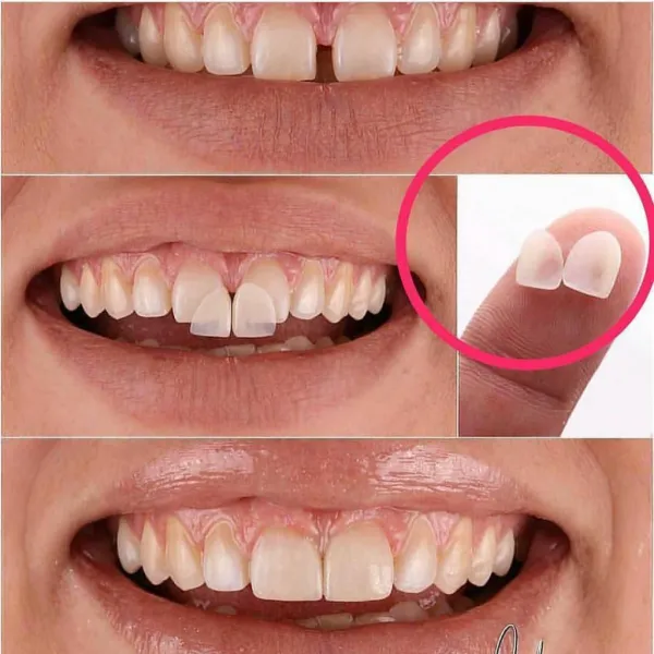 Teeth Implants Nassau County