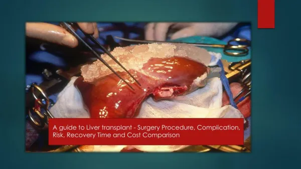 A guide to Liver transplant - Surgery Procedure, Complication, Risk, Recovery Time and Cost Comparison