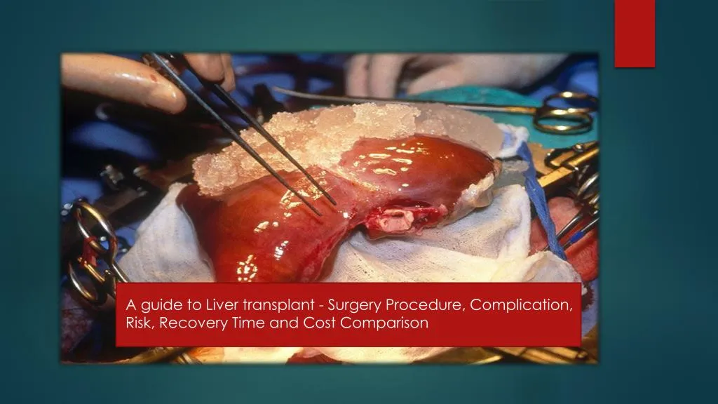 a guide to liver transplant surgery procedure