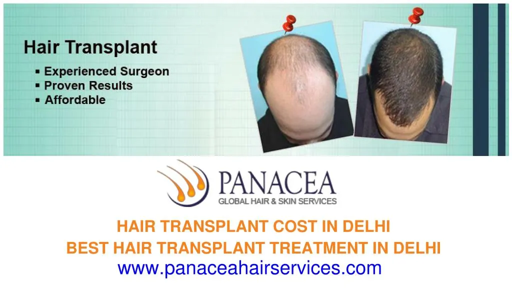 hair transplant cost in delhi best hair