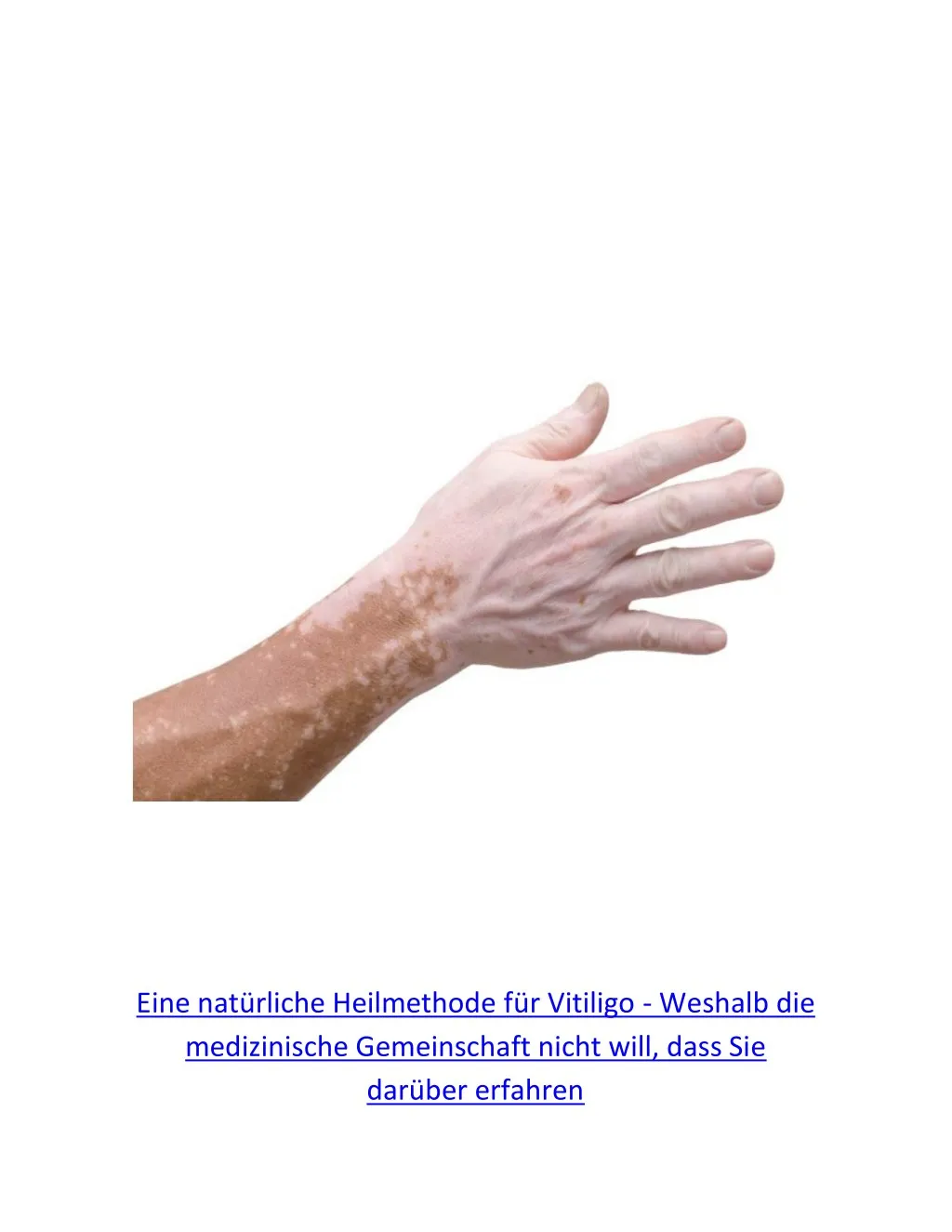 eine nat rliche heilmethode f r vitiligo weshalb