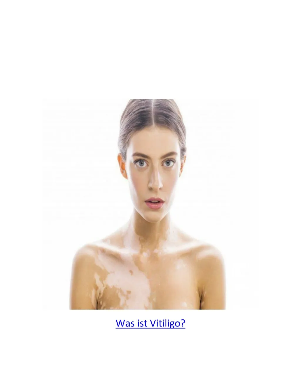 was ist vitiligo
