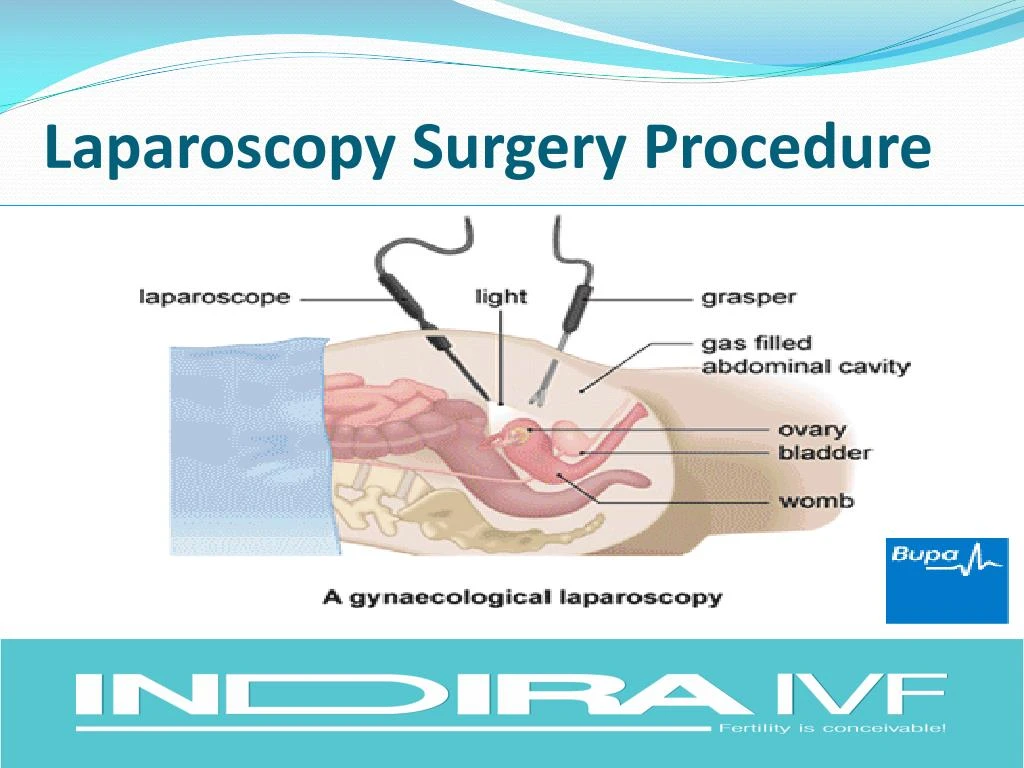 laparoscopy surgery procedure