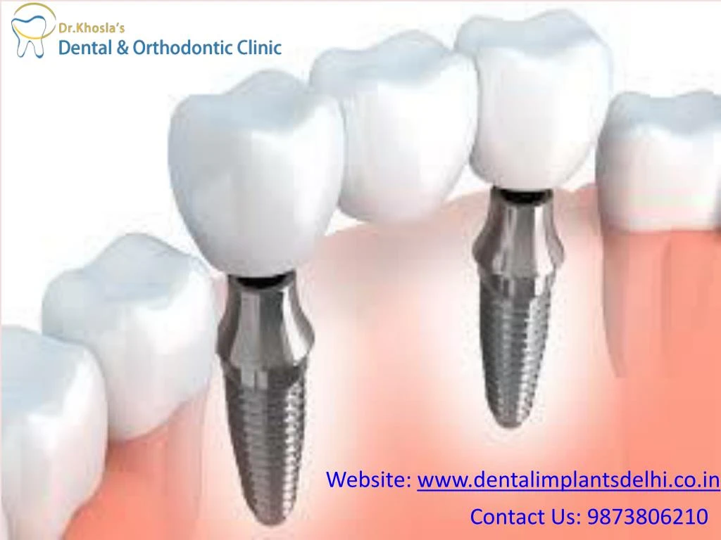 website www dentalimplantsdelhi co in