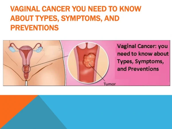 Everything you need to know about vaginal cancer