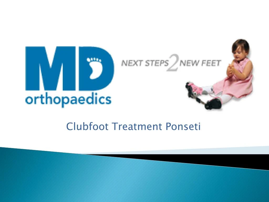 clubfoot treatment ponseti