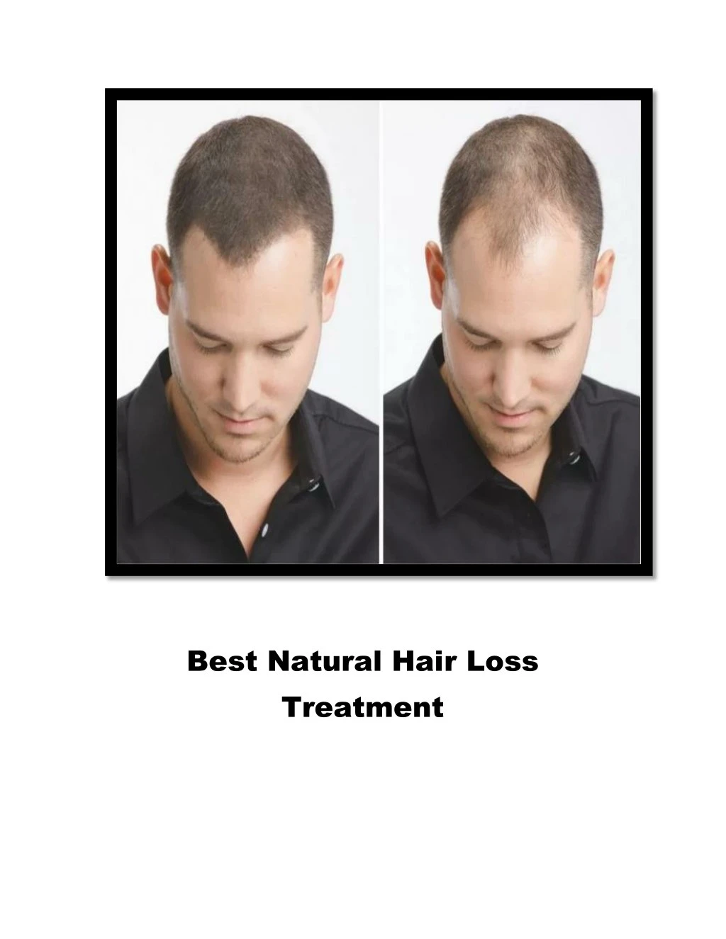 best natural hair loss treatment