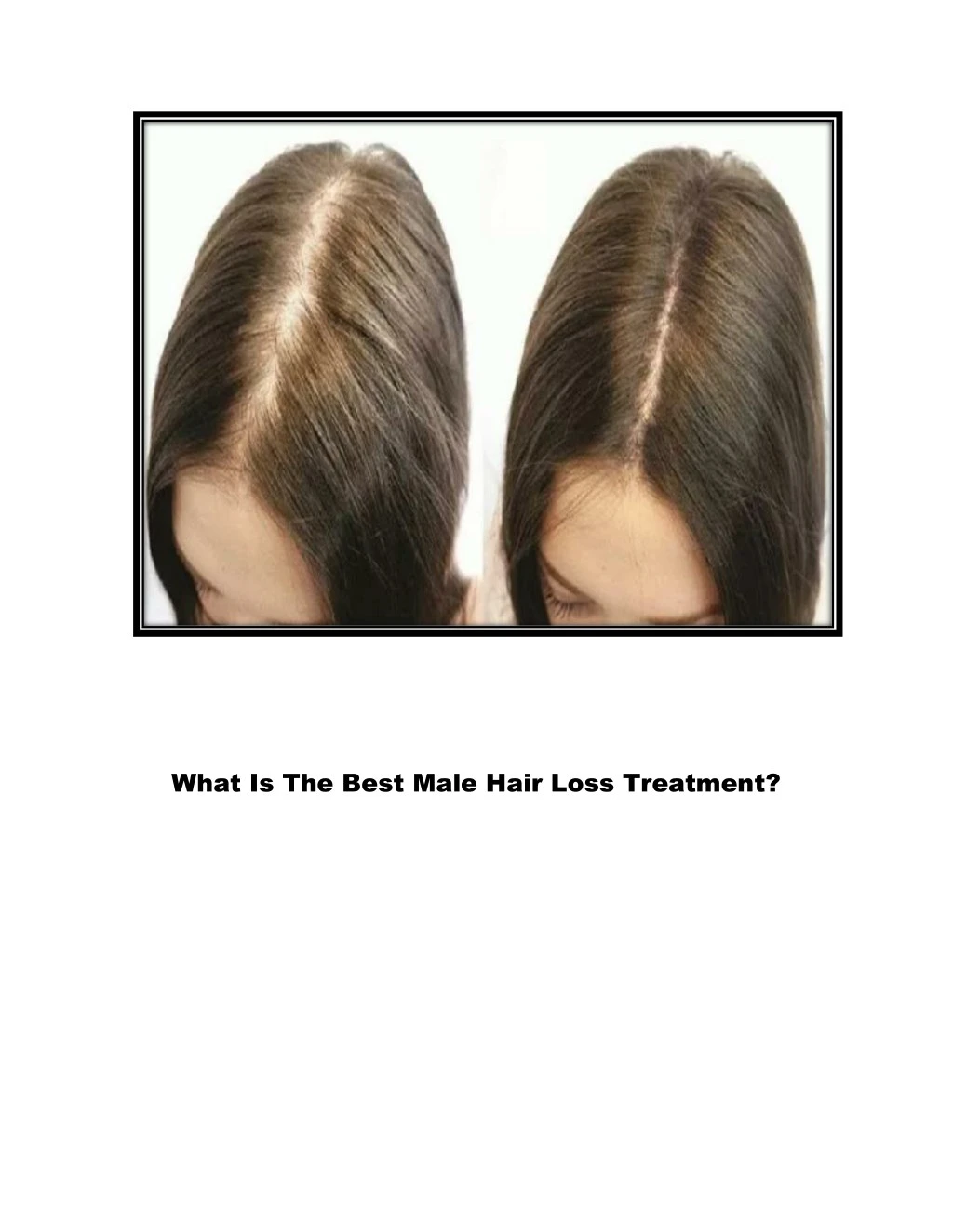 what is the best male hair loss treatment