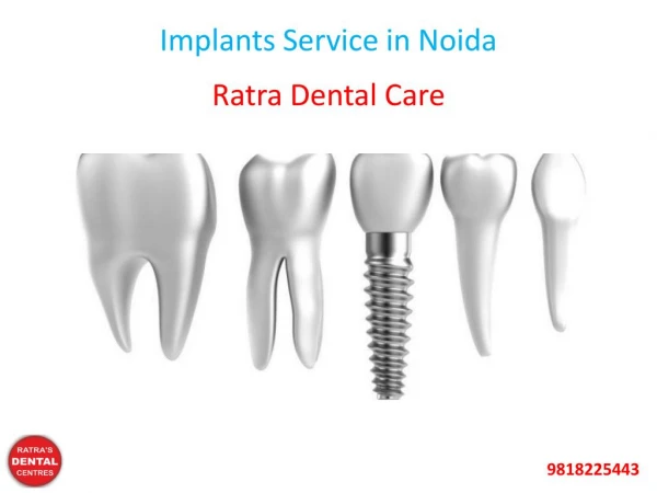 Implants Service in Noida