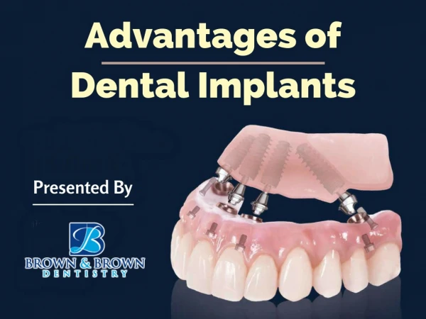 Advantages of Implant Dentistry