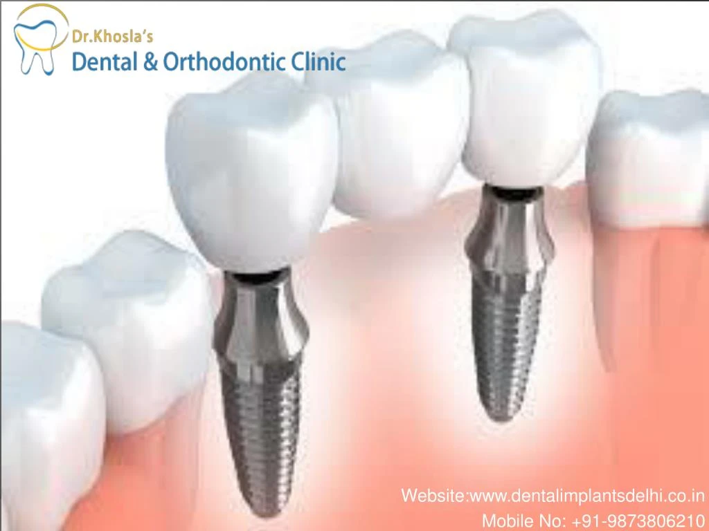 website www dentalimplantsdelhi co in mobile no 91 9873806210